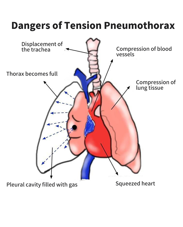 High Quality Disposable Chest Tension Pneumothorax Decompression Needle